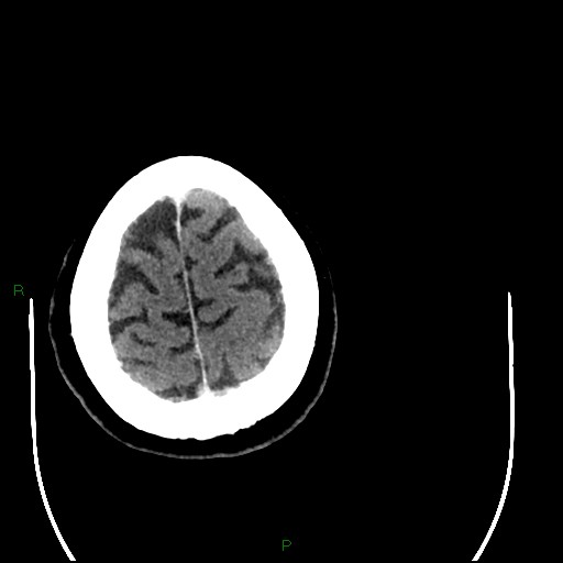 Cerebellar abscess (Radiopaedia 78135-90671 Axial C+ delayed 97).jpg