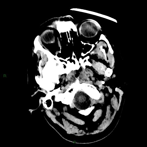 Cerebellar abscess (Radiopaedia 78135-90671 Axial non-contrast 9).jpg