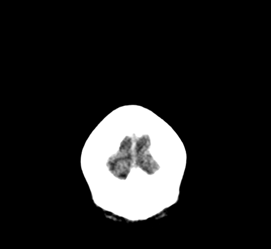 Cerebellar metastases - colorectal adenocarcinoma (Radiopaedia 40947-43652 Coronal non-contrast 11).png