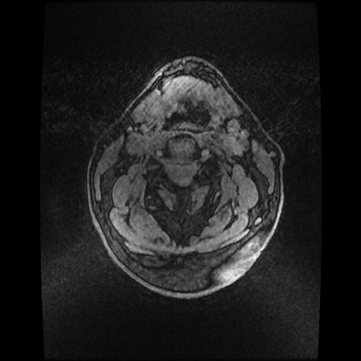 File:Cerebellar metastasis of pulmonary adenocarcinoma, cavernous venous malformation, and developmental venous anomaly (Radiopaedia 85827-101661 Axial T1 C+ 96).jpg