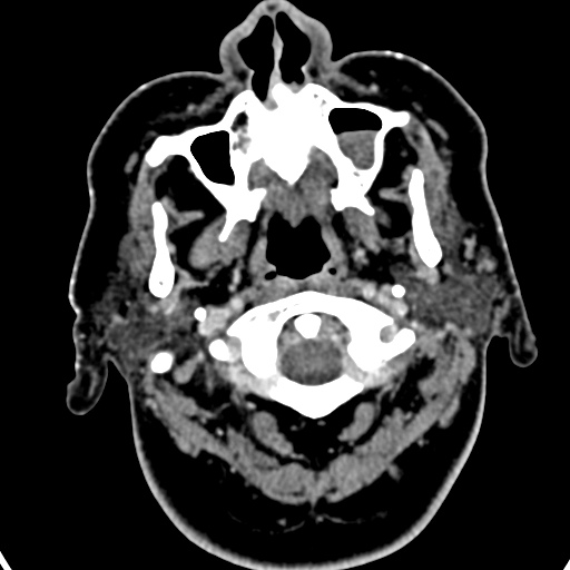 Cerebellopontine angle meningioma (Radiopaedia 35181-36714 A 66).jpg