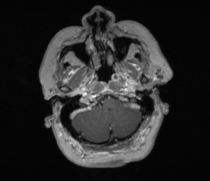 Cerebellopontine angle meningioma (Radiopaedia 35181-36715 Axial T1 C+ 47).jpg