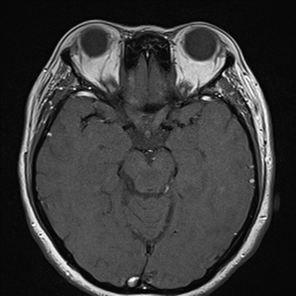 File:Cerebellopontine angle meningioma (Radiopaedia 53561-59591 Axial T1 20).jpg