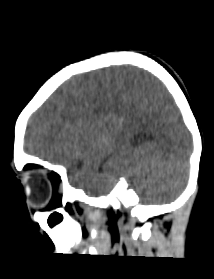 Cerebral abscess (Radiopaedia 24212-24478 Coronal T1 110).jpg