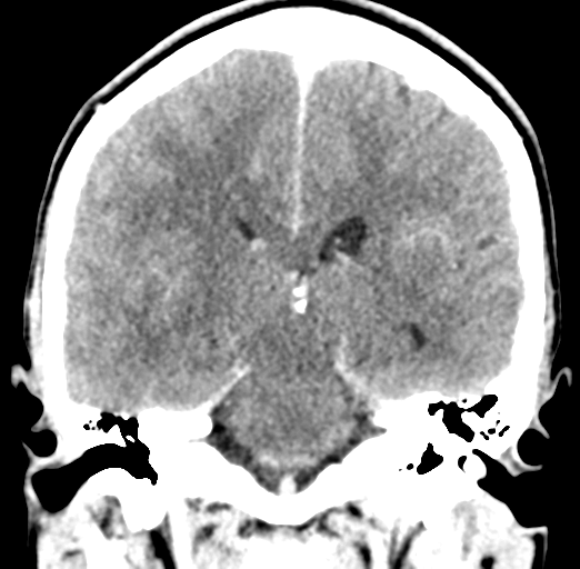 Cerebral abscess (Radiopaedia 60342-68008 Coronal C+ delayed 39).png