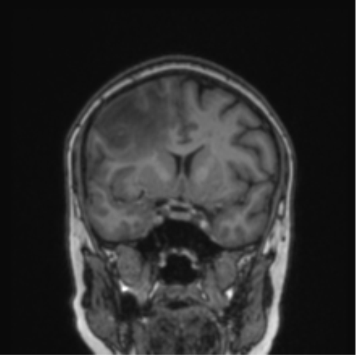 Cerebral abscess from pulmonary arteriovenous malformation (Radiopaedia 86275-102291 Coronal T1 57).png