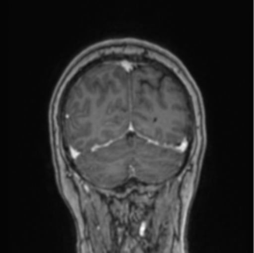 Cerebral abscess from pulmonary arteriovenous malformation (Radiopaedia 86275-102291 L 21).png