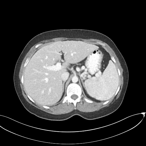 File:Cerebral abscess from pulmonary arteriovenous malformation (Radiopaedia 86275-102292 B 22).png