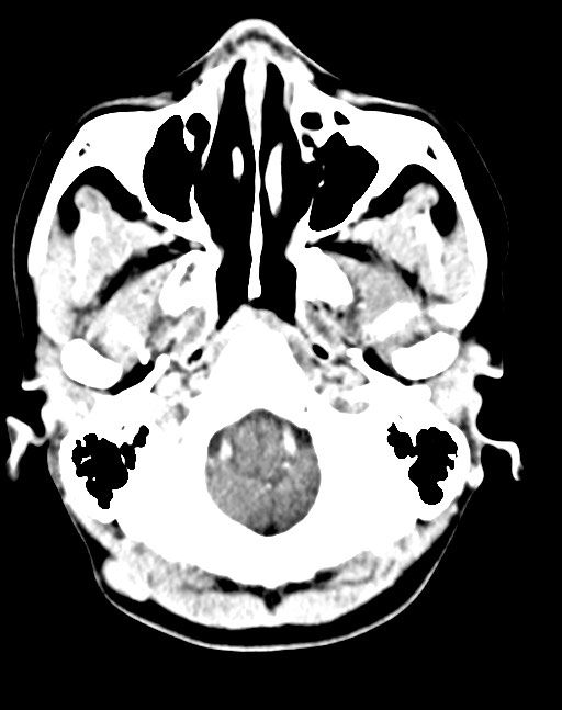 Cerebral abscesses (Radiopaedia 70458-80568 Axial Contrast 13).jpg