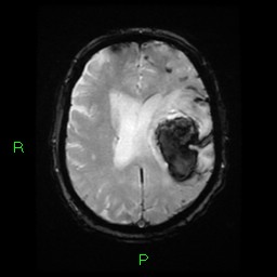 File:Cerebral amyloid angiopathy-associated lobar intracerebral hemorrhage (Radiopaedia 58376-65512 Axial Gradient Echo 10).jpg