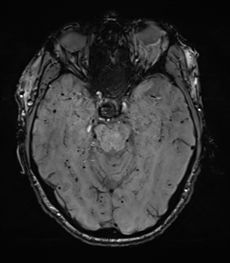 File:Cerebral amyloid angiopathy (Radiopaedia 46082-50433 Axial SWI 30).png