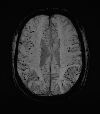 File:Cerebral amyloid angiopathy (Radiopaedia 46082-50433 Axial SWI MIP 52).png