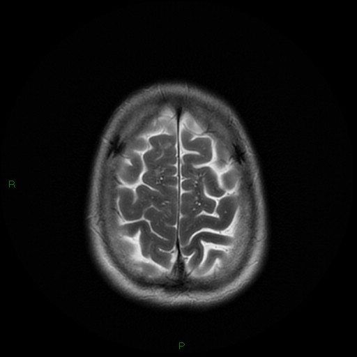 File:Cerebral amyloid angiopathy (Radiopaedia 77506-89664 Axial T2 25).jpg