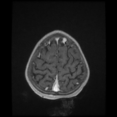 Cerebral and spinal tuberculosis (Radiopaedia 90489-107837 Axial T1 C+ 168).jpg