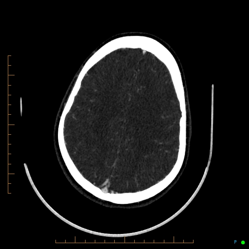 Cerebral arteriovenous malformation (AVM) (Radiopaedia 78162-90706 Axial CTA 202).jpg