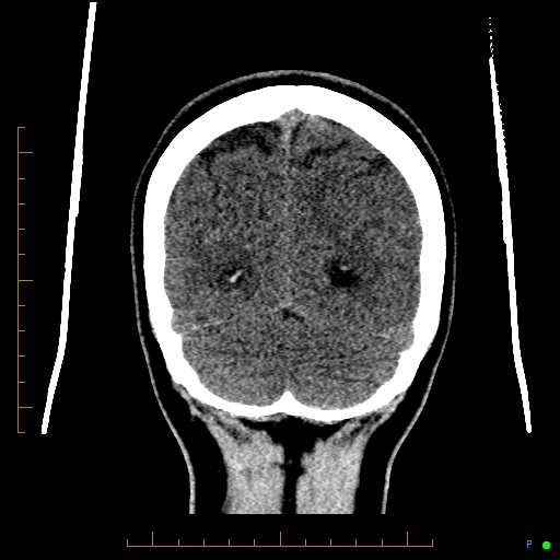 Cerebral arteriovenous malformation (AVM) (Radiopaedia 78162-90706 Coronal non-contrast 81).jpg