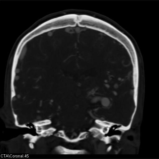 Cerebral arteriovenous malformation (Radiopaedia 28518-28759 C 45).jpg