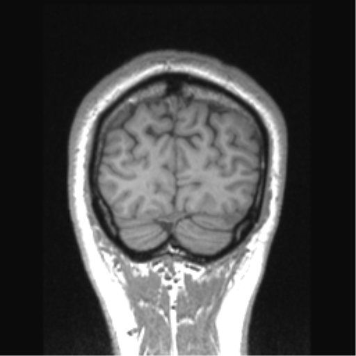 Cerebral arteriovenous malformation (Radiopaedia 39259-41506 Coronal T1 14).png