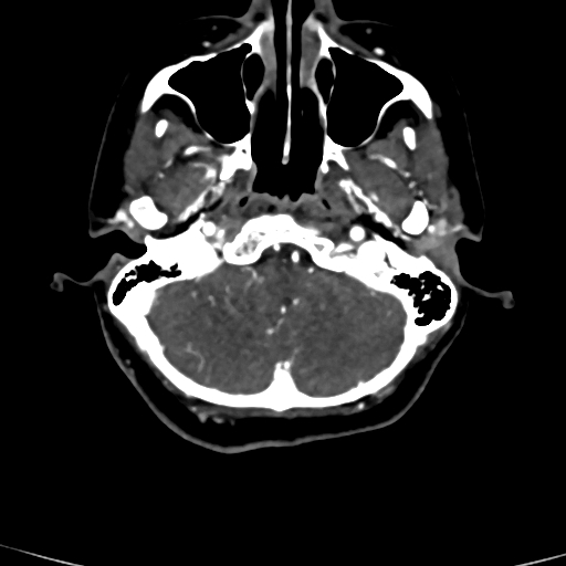 Cerebral arteriovenous malformation (Radiopaedia 73830-84645 Axial C+ delayed 80).jpg