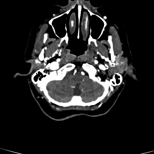 Cerebral arteriovenous malformation (Radiopaedia 73830-84645 Axial C+ delayed 85).jpg