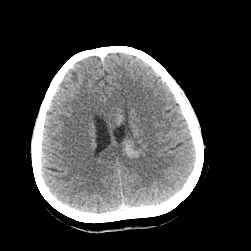 File:Cerebral arteriovenous malformation (Radiopaedia 73830-84645 Axial non-contrast 30).jpg