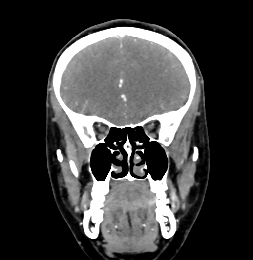 Cerebral arteriovenous malformation (Radiopaedia 73830-84645 C 29).jpg