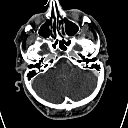 Cerebral arteriovenous malformation (Radiopaedia 78188-90746 Axial C+ delayed 36).jpg