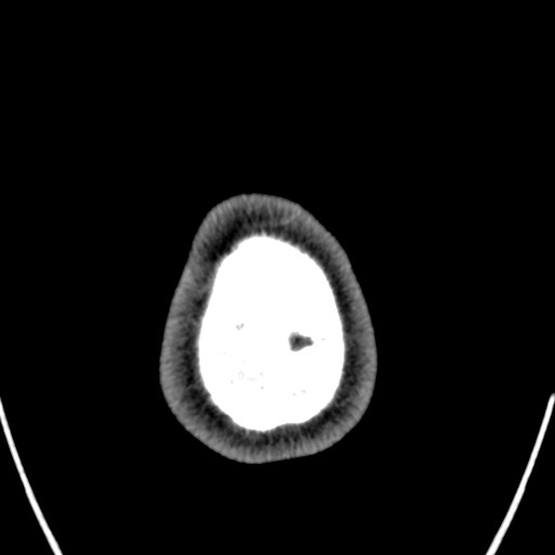 Cerebral arteriovenous malformation (Radiopaedia 78188-90746 Axial non-contrast 178).jpg