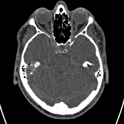 Cerebral arteriovenous malformation (Radiopaedia 78188-90746 Axial non-contrast 56).jpg
