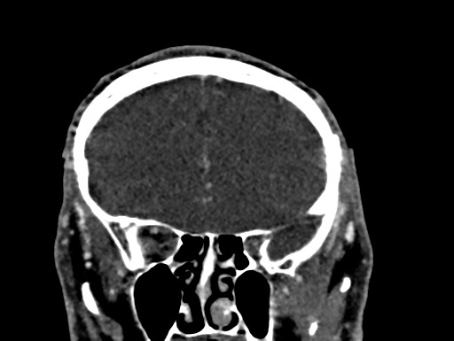 File:Cerebral arteriovenous malformation (Radiopaedia 78188-90746 Coronal C+ delayed 29).jpg