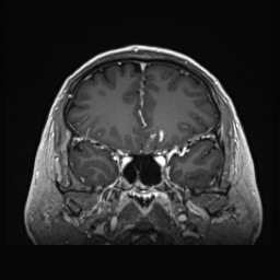 Cerebral arteriovenous malformation (Radiopaedia 84015-99245 Coronal T1 C+ 54).jpg