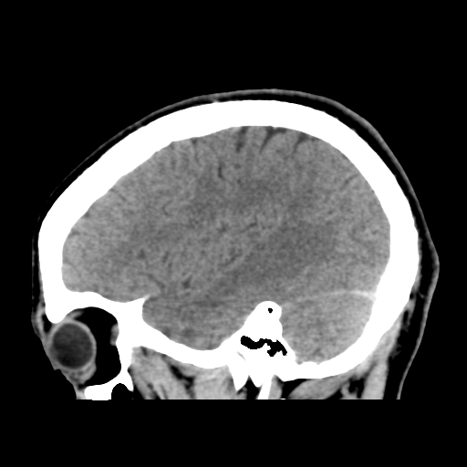 Cerebral arteriovenous malformation (Spetzler-Martin grade 2) (Radiopaedia 41262-44076 A 46).png