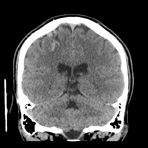 Cerebral arteriovenous malformation (Spetzler-Martin grade 2) (Radiopaedia 41262-44076 Coronal non-contrast 41).png