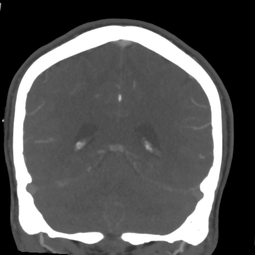 Cerebral arteriovenous malformation (Spetzler-Martin grade 2) (Radiopaedia 41262-44076 F 46).png
