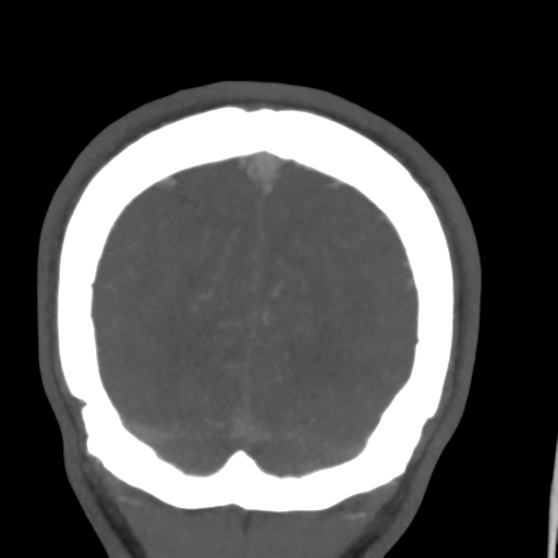 Cerebral arteriovenous malformation (Spetzler-Martin grade 2) (Radiopaedia 41262-44076 F 57).png