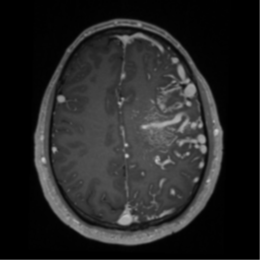 Cerebral arteriovenous malformation - huge (Radiopaedia 35734-37272 Axial T1 C+ 52).png