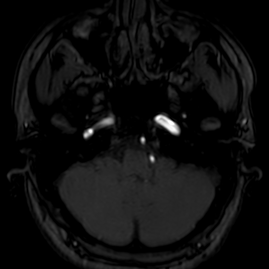 Cerebral arteriovenous malformation at posterior body of corpus callosum (Radiopaedia 74111-84925 Axial MRA 32).jpg