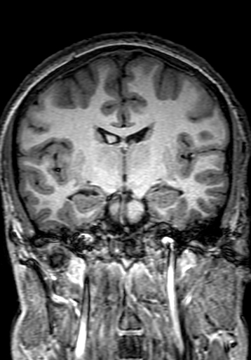 Cerebral arteriovenous malformation at posterior body of corpus callosum (Radiopaedia 74111-84925 Coronal T1 162).jpg