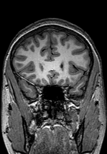 Cerebral arteriovenous malformation at posterior body of corpus callosum (Radiopaedia 74111-84925 Coronal T1 85).jpg