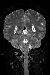 Cerebral arteriovenous malformation at posterior body of corpus callosum (Radiopaedia 74111-84925 Coronal T2 121).jpg