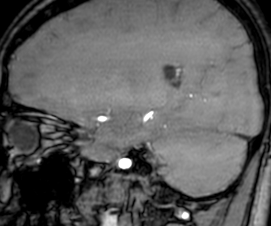 File:Cerebral arteriovenous malformation at posterior body of corpus callosum (Radiopaedia 74111-84925 J 127).jpg