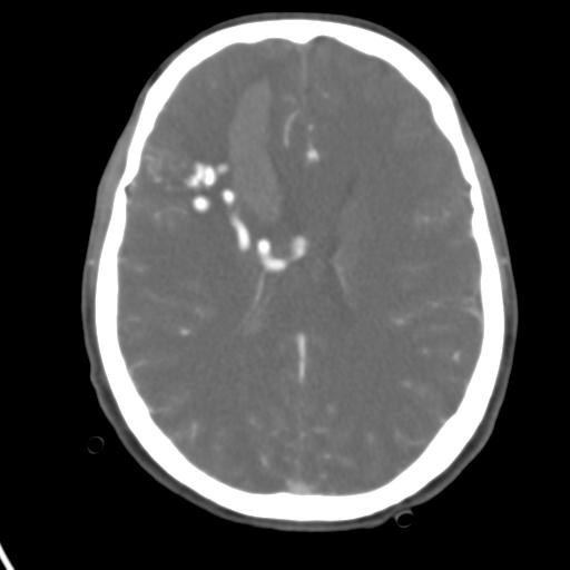 Cerebral arteriovenous malformation with hemorrhage (Radiopaedia 28773-29073 A 23).jpg