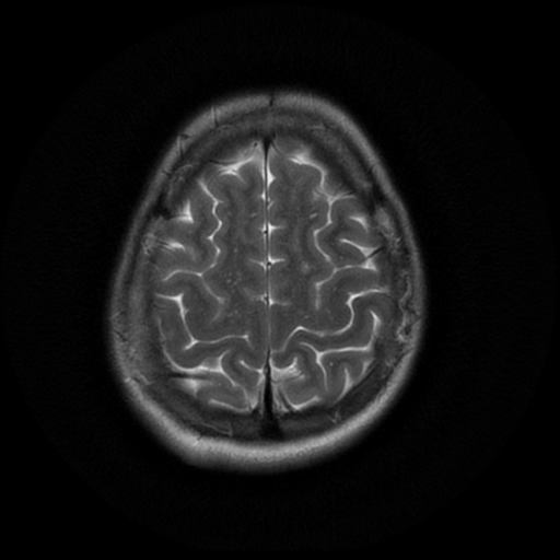 File:Cerebral autosomal dominant arteriopathy with subcortical infarcts and leukoencephalopathy (CADASIL) (Radiopaedia 41018-43763 Ax T2 PROP 17).png