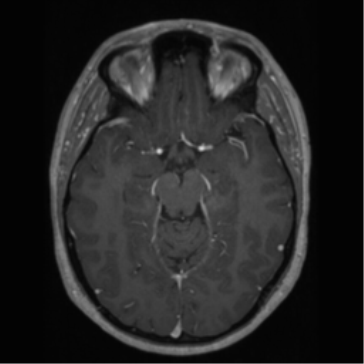 Cerebral cavernoma and development venous anomaly (Radiopaedia 37603-39482 Axial T1 C+ 31).png