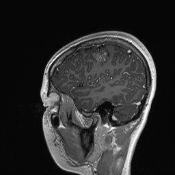 File:Cerebral cavernous venous malformation (Radiopaedia 70008-80021 Sagittal T1 C+ 14).jpg