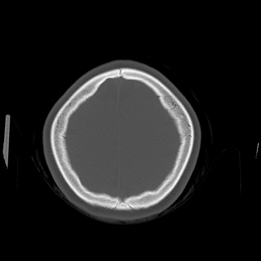 Cerebral cavernous venous malformation (Radiopaedia 70008-80022 Axial bone window 47).jpg