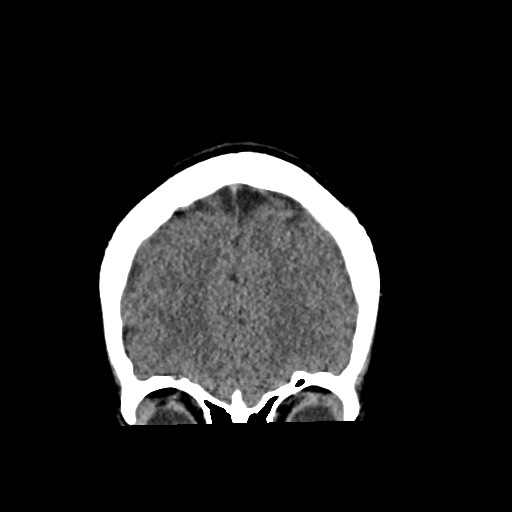 File:Cerebral cavernous venous malformation (Radiopaedia 70008-80022 non-contrast 14).jpg