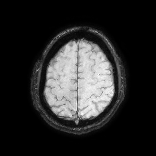 File:Cerebral cavernous venous malformation (Zabramski type II) (Radiopaedia 85511-101198 Axial SWI 96).jpg