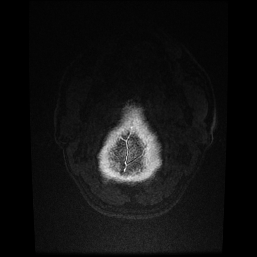 Cerebral cavernous venous malformation (Zabramski type II) (Radiopaedia 85511-101198 Axial T1 C+ fat sat 5).jpg