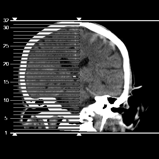 File:Cerebral contusions, subarachnoid hemorrhage and subdural hygromas (Radiopaedia 55399-61827 Axial non-contrast 1).png